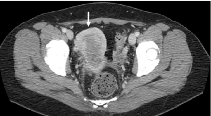 Fig. 3. Follow-up PET-CT scan after eight months.