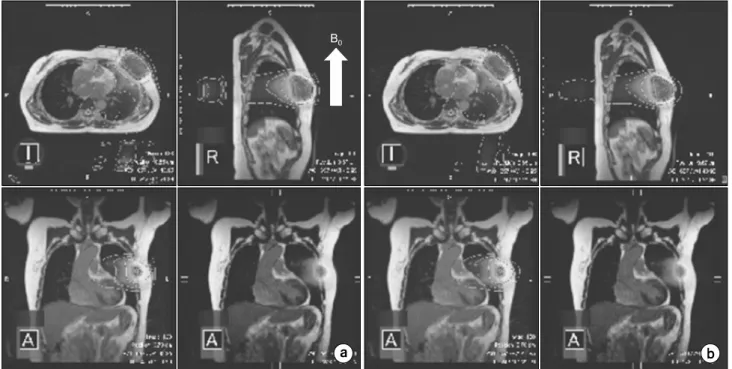 Fig.  1.  The  comparison  of  dose  distribution  for  (a)  with  magnet  field  and  (b)  without  magnet  field  in  the  case  of  PBI  patient  with  a  magnet  field  (B 0 ).
