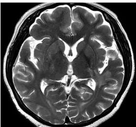 Fig. 3. After two months of steroid therapy, the irregular hyperintense  lesion markedly decreases in size; the lesion have been located in the  left temporal lobe, midbrain, internal capsule, external capsule, and  posterior thalamus on the axial T2-weigh