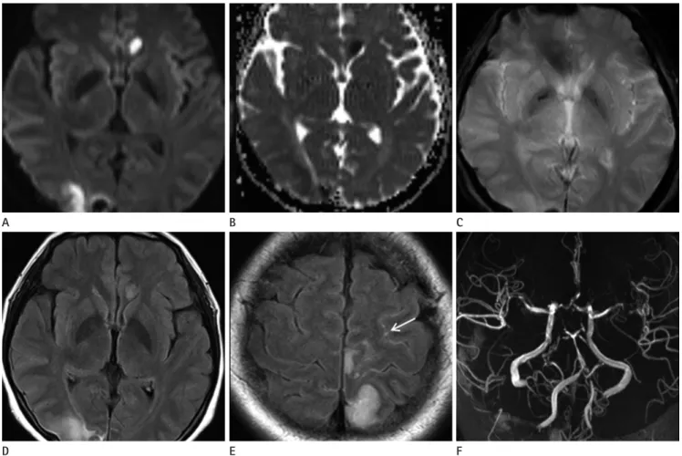 Fig. 1. MR imaging features of RCVS in a 46-year-old woman.