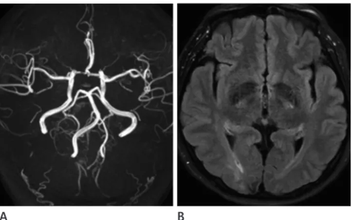 Fig. 2. Follow-up MR imaging 3 months after initial attack of RCVS. 