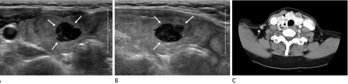 Fig. 2. Thyroid ultrasonography and enhanced neck CT images.