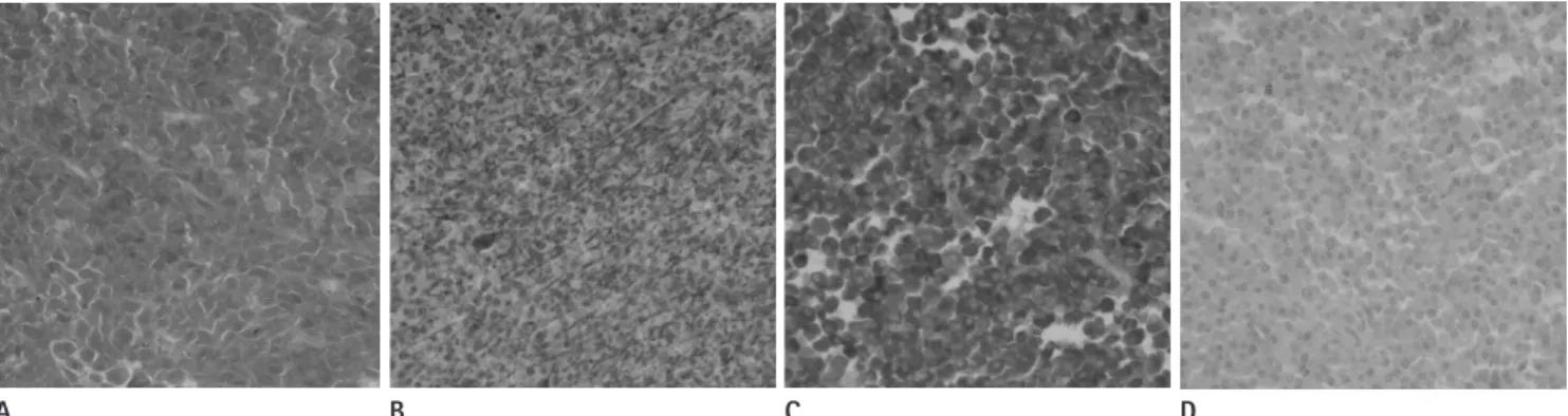 Fig. 4. Immunohistochemical stainings for lambda (A), CD138 (B), and CD79a (C) show positive immunoreactivity, however negative immuno- immuno-reactivity in CD20 (D).