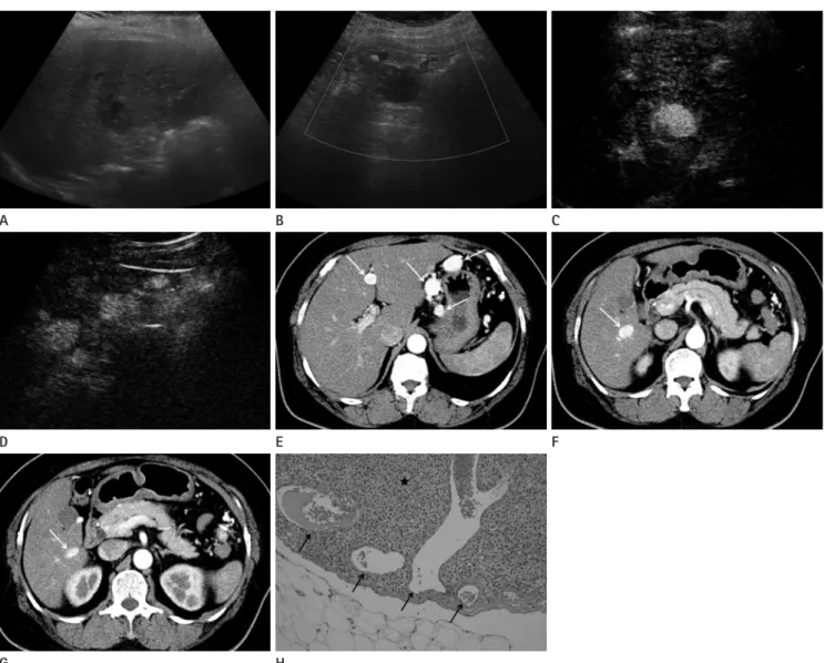 Fig. 2. Recurrent ovarian steroid cell tumor presenting peritoneal seeding after 5 years and 10 months in same patient of Fig
