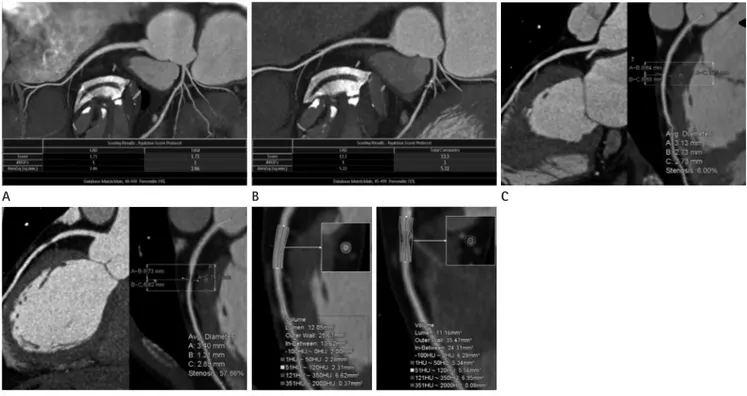 Fig. 1. Plaque progression in the left anterior descending (LAD) coronary artery at baseline and at the 20 month follow-up in a 43-year-old male  patient