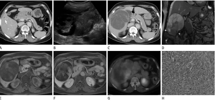 Fig. 1. A 64-year female with undifferentiated embryonal sarcoma of the liver.