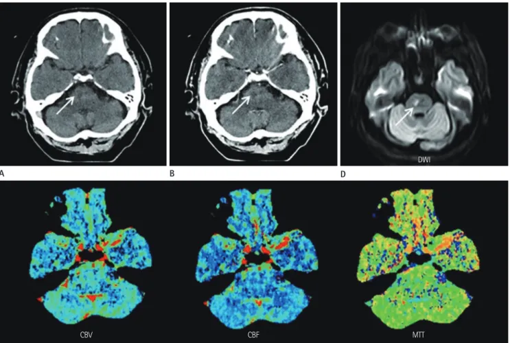 Fig. 2. A case of abnormal finding on conventional CT, but not identified by CTP in right pontine infarction