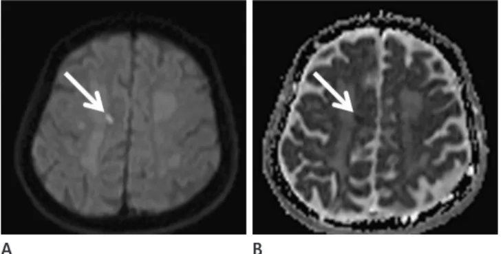 Fig. 1. A 78-year-old male with mild cognitive impairment. Focal in- in-creased signal intensity (A) is noted in right deep white matter on trace  map of diffusion tensor images (arrow)