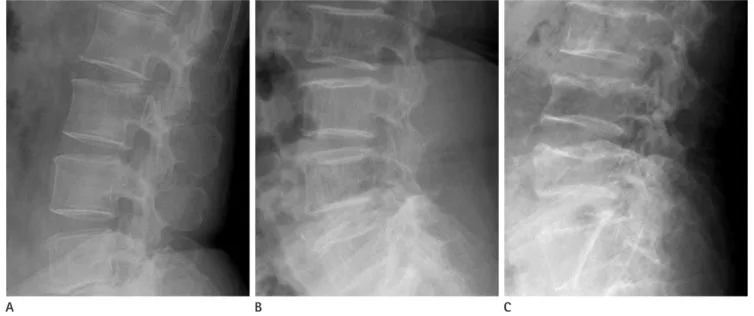 Table 1. Comparison of Spine and Femoral Neck BMD in Both MM and Control Group