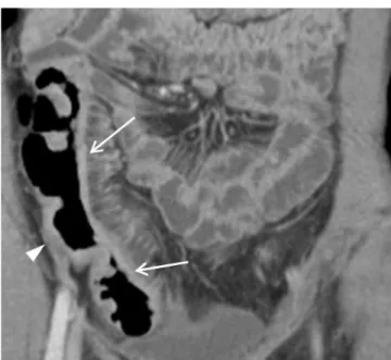 Table 5. Statistical Analysis and Significantly More Detected on  Coronal Image