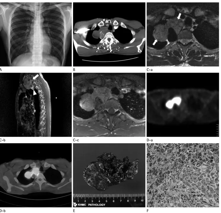 Fig. 1. Imaging findings of superior mediastinal mass in a 32-year-old man.