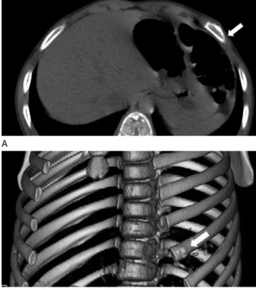 Fig. 5. Focal lipomatosis in a 12-year-old girl presenting with a poste- poste-rior chest wall lump
