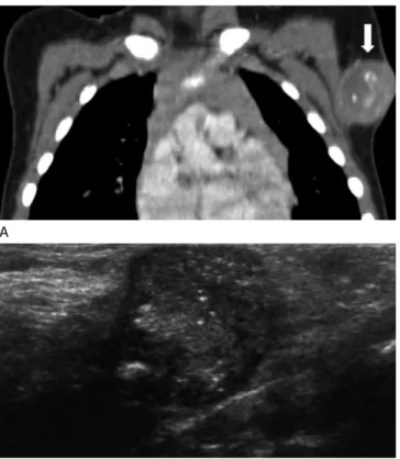 Fig.  9. BCG lymphadenitis in a 22-month-old boy who presented  with persistent axillary mass of 7 months’ duration.