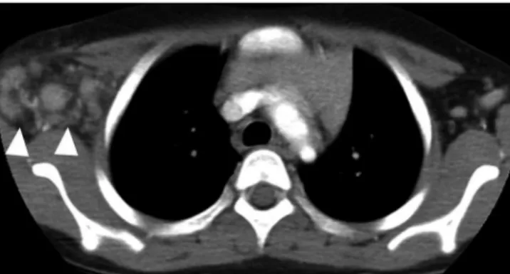 Fig. 10. Acute axillary lymphadenitis in a 6-year-old girl presenting  with a two-week history of palpable, growing mass with pain and  fe-ver on the right axilla