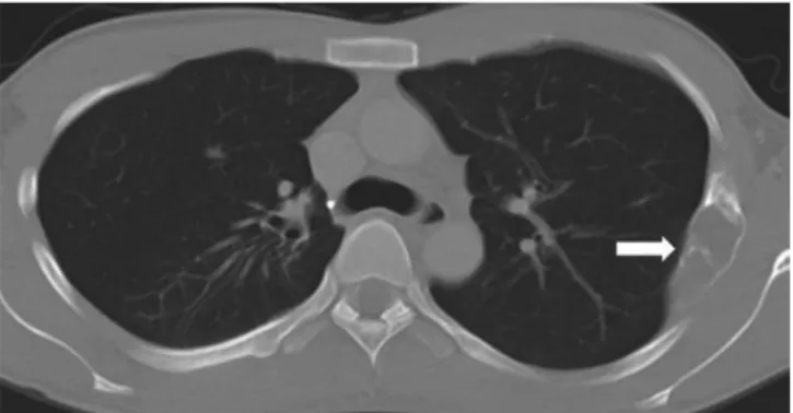 Fig. 20. Aneurysmal bone cyst in a 13-year-old boy who presented  with a palpable mass on the right chest wall one week ago