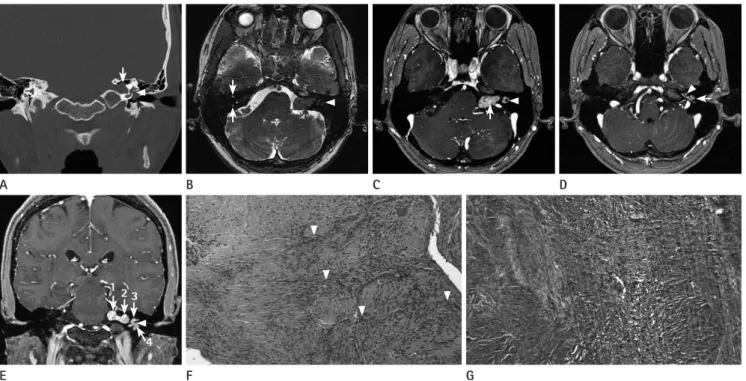 Fig. 1. CT, MRI, and pathologic features of transotic schwannoma in a 38-year-old woman