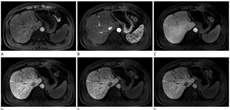 Fig. 3. MR images in 57-year-old man with HCC (arrow) in liver segment IV. Preenhanced image (A), gadoxetic acid-enhanced T1WIs obtained  30 s (B), 180 s (C), 10 minutes (D), 15 minutes (E) and 20 minutes (F) after contrast injection show a 1 cm HCC