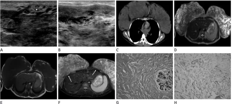 Fig. 1. A 19-year-old female has massive enlargement of both breasts. 