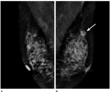 Fig. 3. A 46-year-old woman with screening-detected invasive lobu- lobu-lar carcinoma in her left breast
