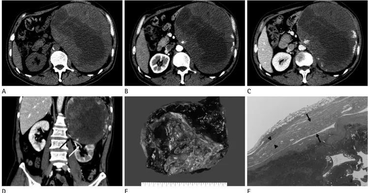 Fig. 1. A 57-year-old man with chronic expanding hematoma of the left adrenal gland.