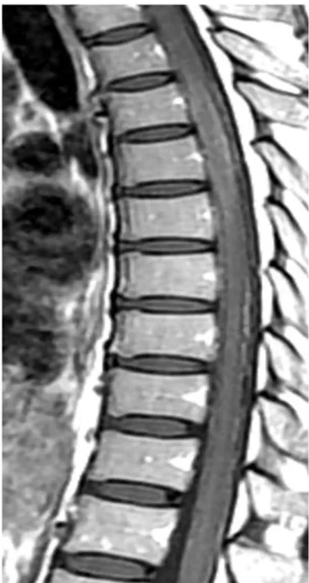 Fig. 2. Type B. 1st attack of acute myelitis in patient 7. Contrasted en- en-hanced T1-weighted sagittal image shows subtle diffuse  heteroge-neous contrast enhancement