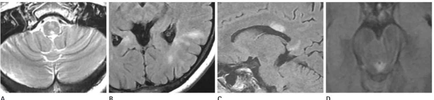 Fig. 6. Variable located high signal intensity lesions of the brain on fluid attenuated inversion recovery (FLAIR) or T2-weighted image in patient 7  (A-C) and patient 6 (D).