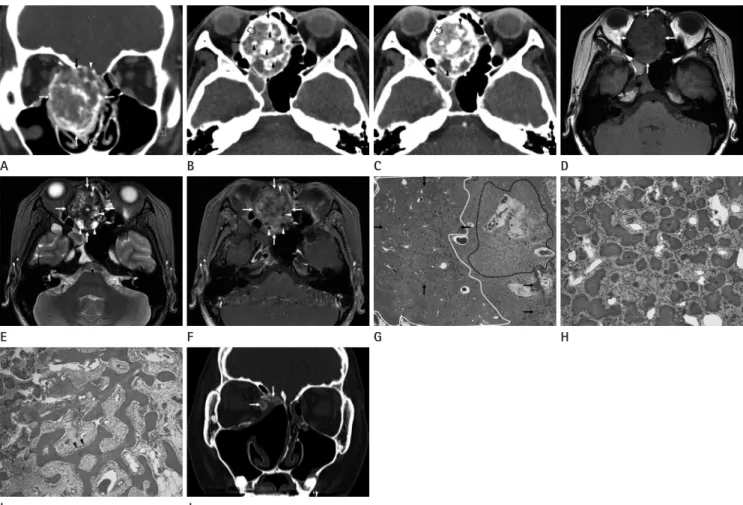 Fig. 1. CT, MRI, and pathologic features of psammomatoid juvenile ossifying fibroma of the right middle turbinate in an 18-year-old adolescent  female