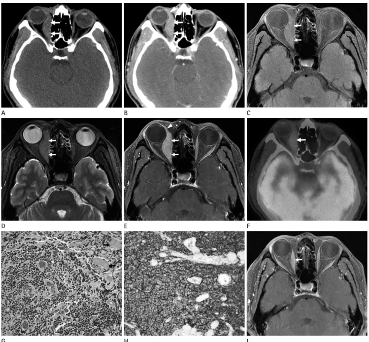 Fig. 1. CT, MRI,  18 F-FDG PET/CT, and pathologic features of MALT lymphoma involving the medial rectus muscle in a 47-year-old man.