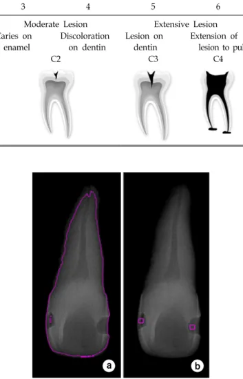 Table 1. Tooth status corresponding to ICDAS and four stages of tooth decay.