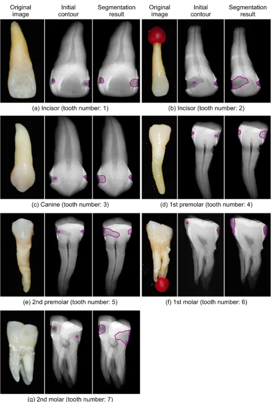 Fig.  4.  The  dental  cavities  of  the  7  tooth  phantoms  are  segmented  from  the  7  tooth  phantoms  after  being  applied  edge-based  active  contour  algorithm