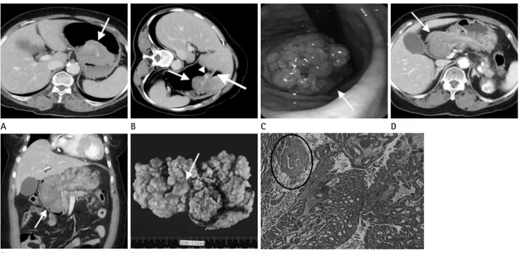 Fig. 1. A 79-year-old woman who presented with gastric intussusceptions due to a giant hyperplastic polyp with intraepithelial malignant trans- trans-formation.