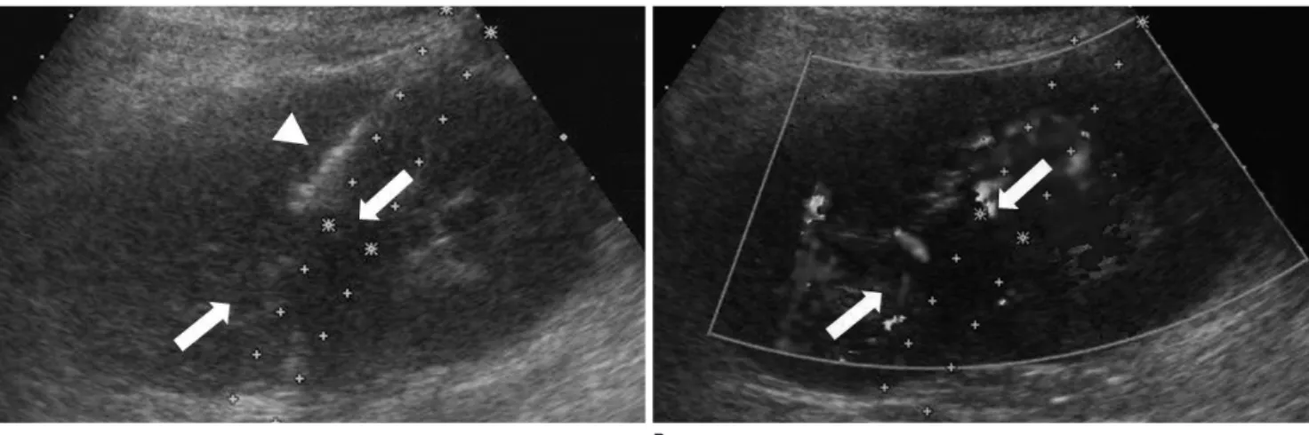 Fig. 3. Longitudinal gray scale sonogram of the right kidney (A) show hypo to intermediate echogenic mass (arrows) in renal pelvis without def- def-inite combined hydronephrosis