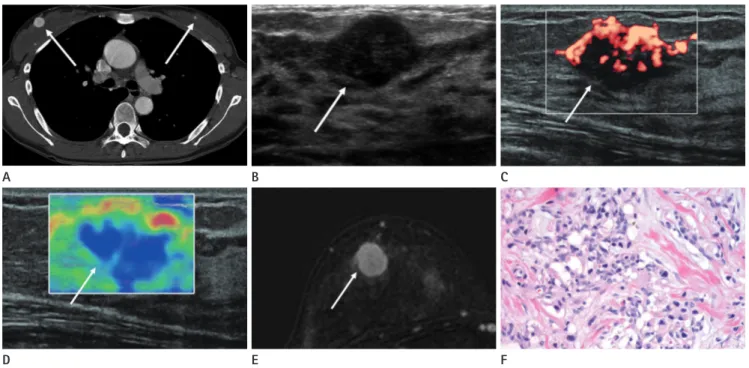 Fig. 1. A 32-year-old woman with metastatic paraganglioma of the right breast.