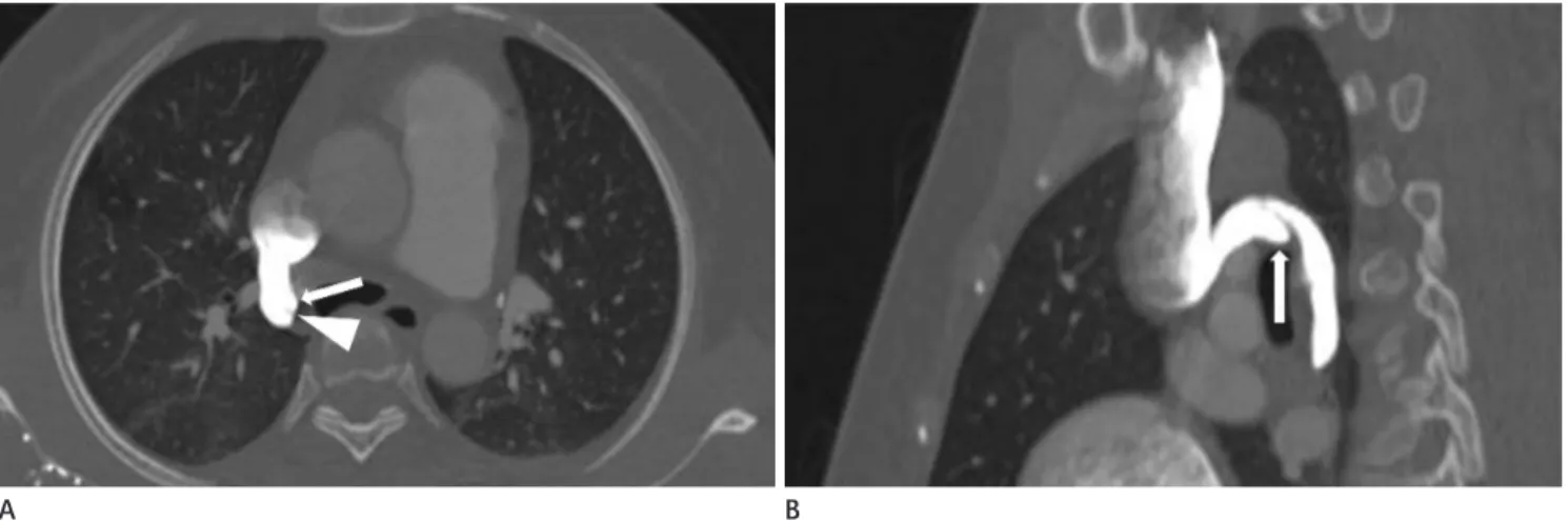 Fig. 3. Azygos fissure in a 36-year-old man.