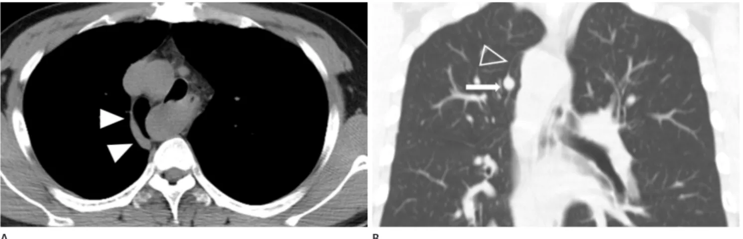 Fig. 4. Azygos fissure with right sided aortic arch in a 32-year-old man.
