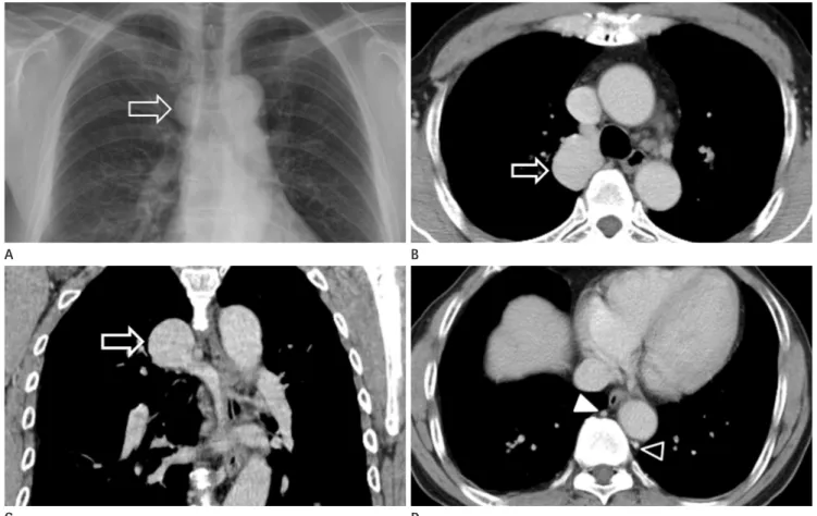 Fig. 8. Azygos vein varix in a 58-year-old man who presented as incidentally detected mediastinal mass.