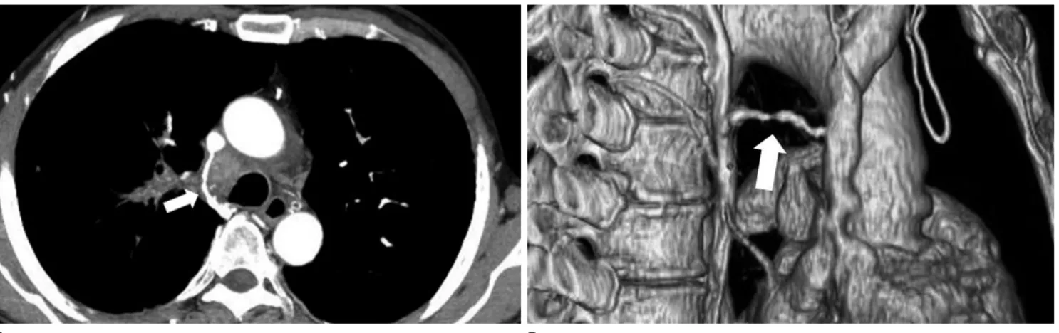 Fig. 9. Tumor invasion of azygos arch in a 49-year-old man. He was confirmed to be suffering from small cell carcinoma of lung