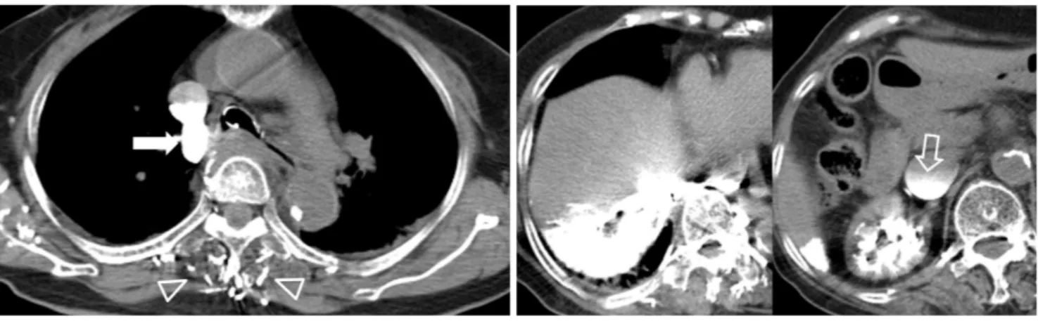 Fig. 12. Cardiac arrest during CT scanning in an 81-year-old woman.