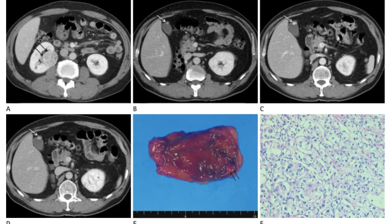 Fig. 1. A 58-year-old man who presented with a metastasis in the gallbladder from renal cell carcinoma (RCC).