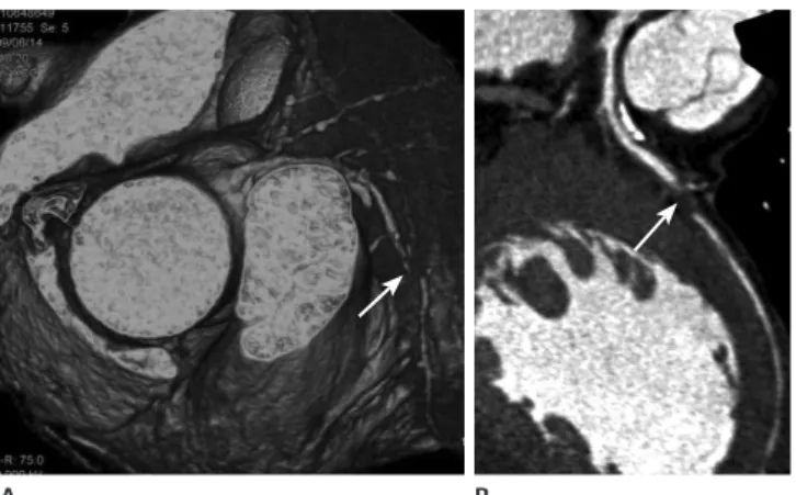 Fig. 1. A 48-year-old male with acute chest pain. Volume rendering  image (A) reveals complete interruption of coronary artery at mid left  anterior descending artery (arrow)