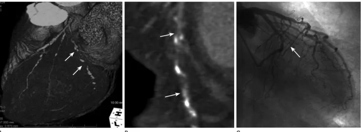 Fig. 2. A 71-year-old male with acute chest pain. Volume rendering image (A) and curved multiplanar image (B) reveals diffuse occlusion of left  circumflex coronary artery with multifocal calcified plaques (arrows), which is confirmed by conventional angio