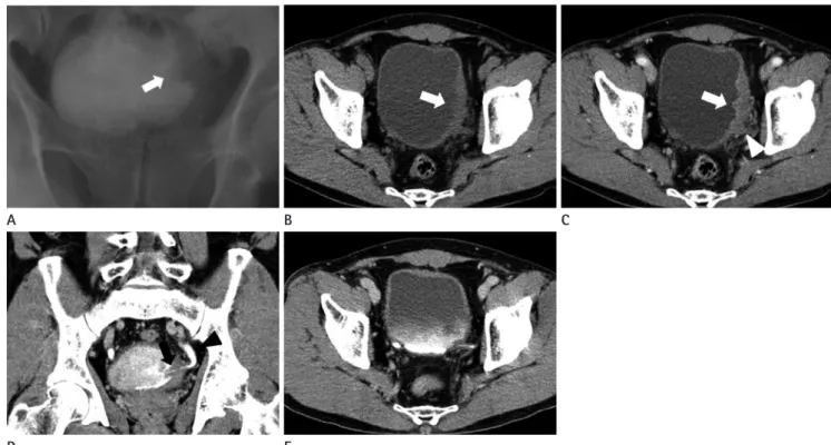 Fig. 1. Intravenous pyelogram and CT. Intravenous pyelogram (A) reveals diffuse ill-defined filling defect and wall irregularity (arrow) at the left  wall of the urinary bladder