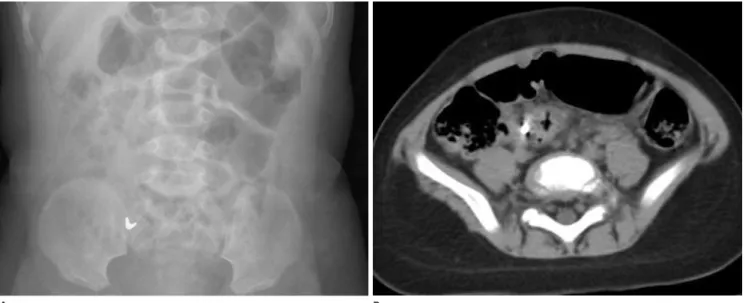 Fig. 4. Delayed passage of a small metallic foreign body five months after ingestion. A 11-month-old girl swallowed a part of cell phone chain.