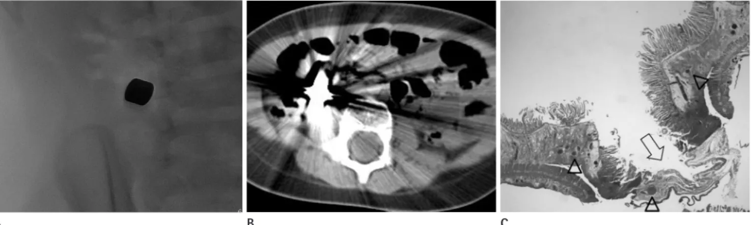 Fig. 8. Multiple small bowel perforation by abutting magnets. A 17-month-old boy presented vomiting about 5 hours ago