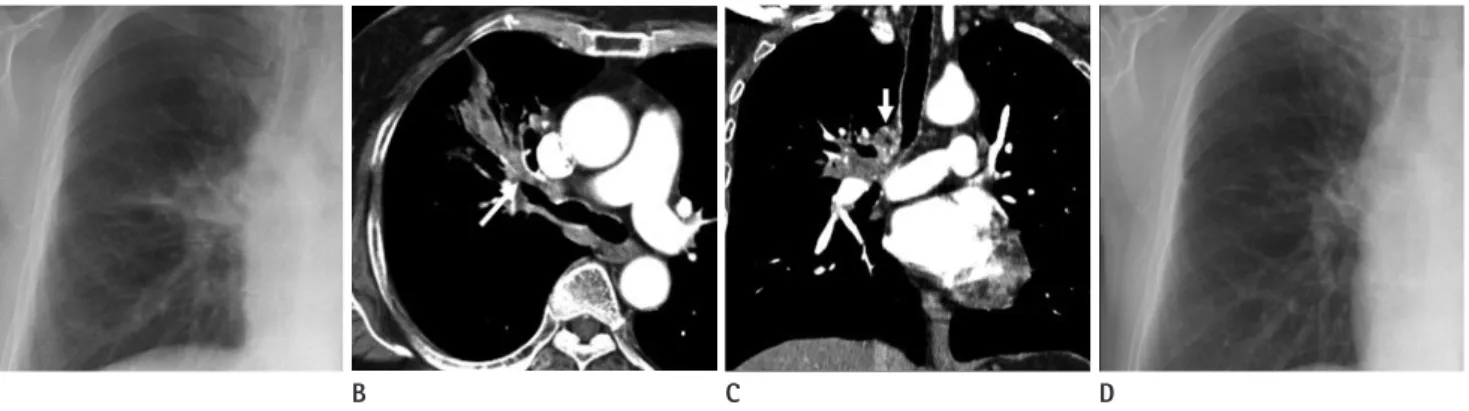 Fig. 2. Pattern 2: Bronchial obstruction with central mass-like lesion.