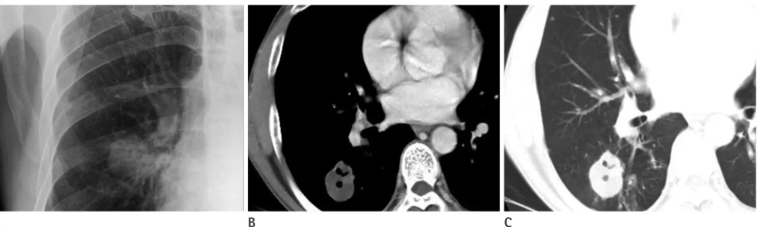 Fig. 5. Pattern 4: Cavitary lesion with homogeneous low-attenuated wall. 