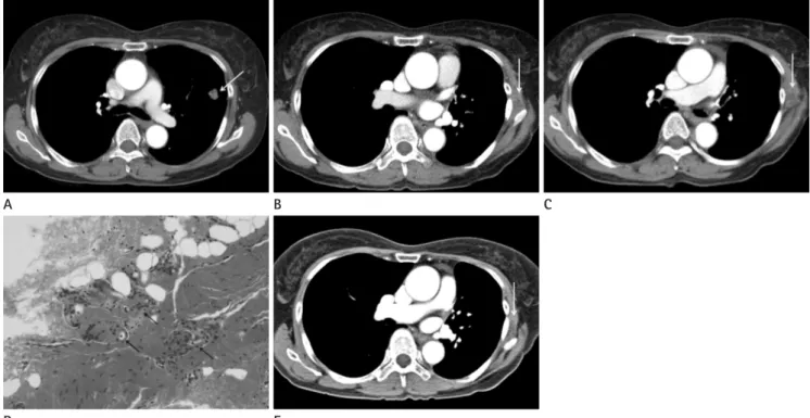 Fig. 1. 65-year-old woman with lung cancer in the left upper lobe and suture granuloma in the left lateral chest wall.