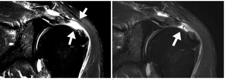Fig. 2. 57-year-old man with partial articular supraspinatus tendon avulsion confirmed by arthroscopy