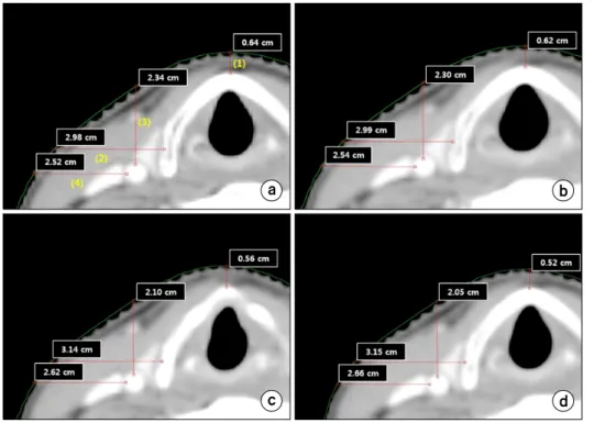 Fig.  2.  Measurement  and  compari- compari-son  of  the  distances  between  skin  surface  and  each  4  points  (OARs)  in  a  typical  patient