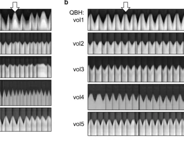 Fig.  2.  Upper  liver  breath-hold  mo- mo-tion  obtained  using  the  RF   naviga-tor  pre-pulse  with  (a)  FB  and  (b)  QBH  biofeedback  breathing